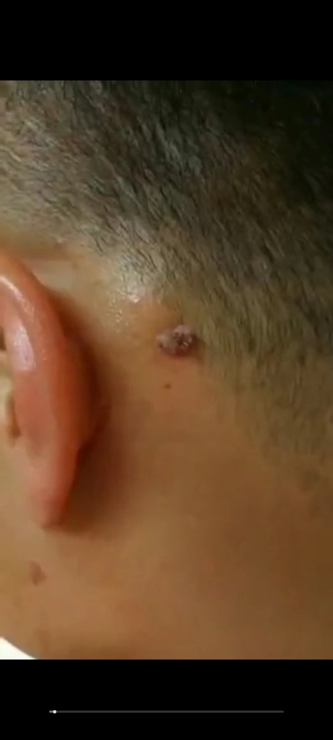 图片[2]-痣祛‬点痣方法（视频+药方）-真传国学